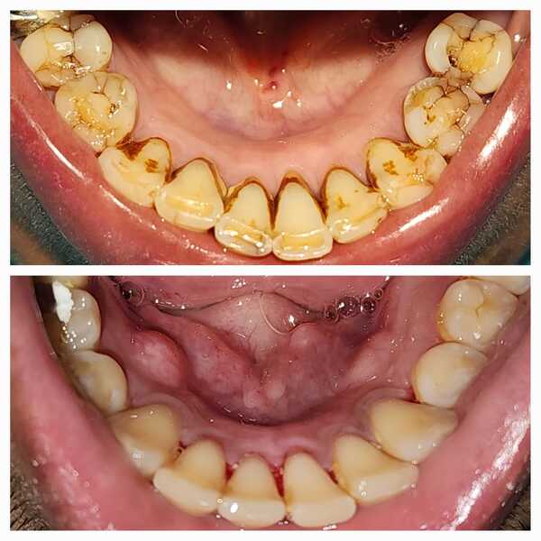 BEST AESTHETIC DENTISTRYIMPLANT OF PAKISTANCLIFTONKARACHI