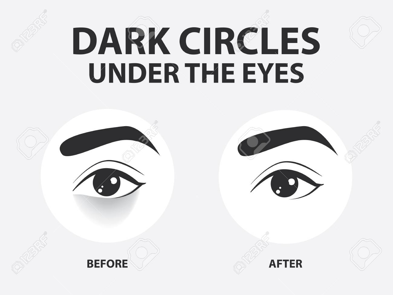 111076256 removal of dark circles under the eyes vector illustration